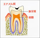 「C1」歯の表面（エナメル質）のむし歯