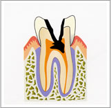 神経まで達したむし歯